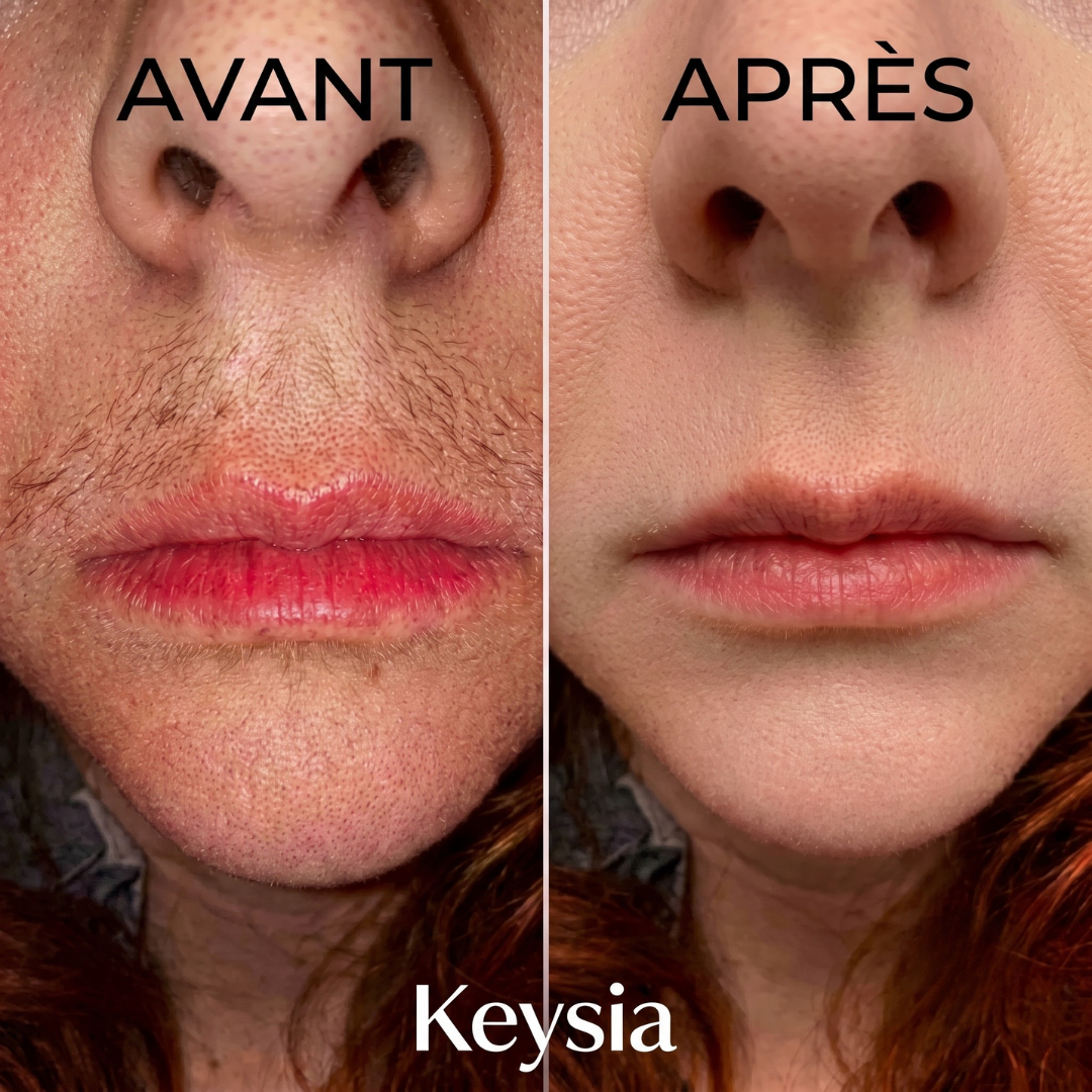 Keysia Sérum - Stop naturel à la pousse des poils
