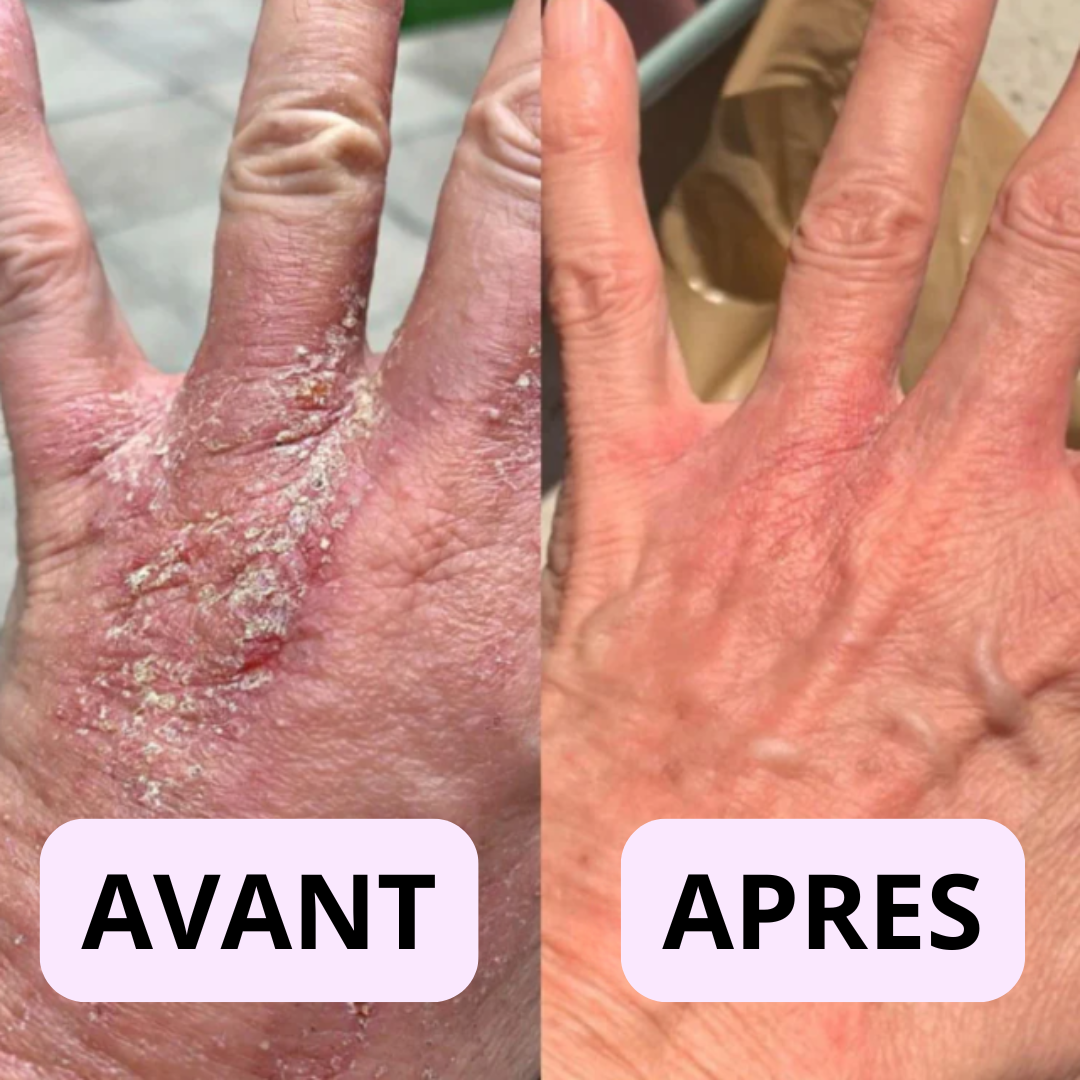 Keysia Skin — Le Baume Réparateur Anti-Eczéma & Anti-Psoriasis